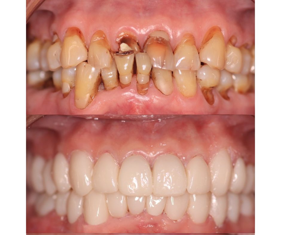 Full Mouth Rehabilitation