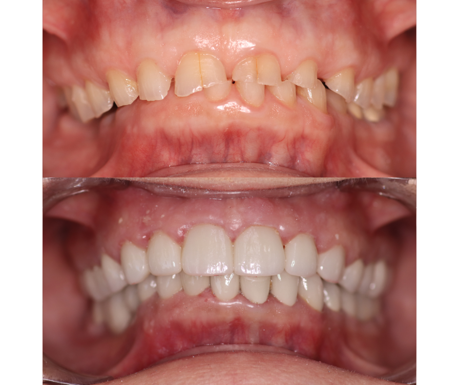 Full Smile Makeover before and after