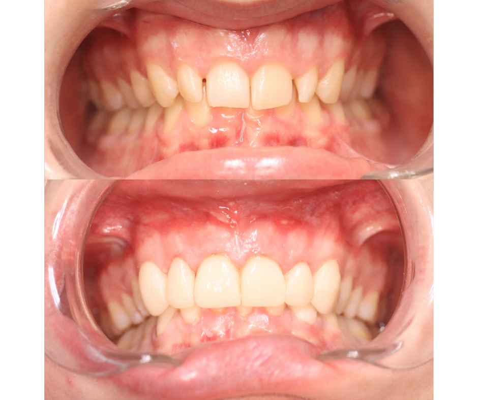 Full Mouth Rehabilitation