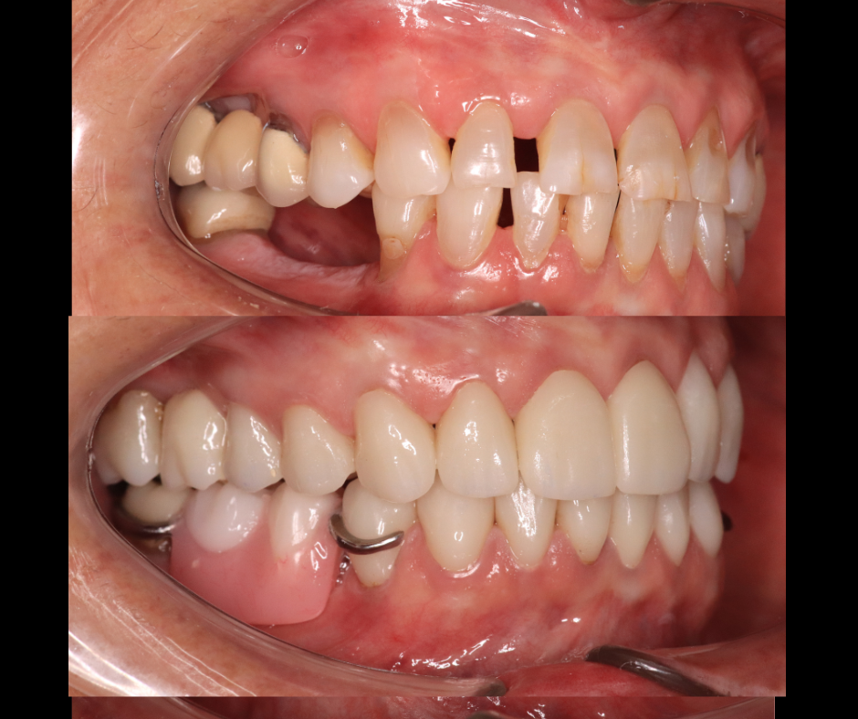 Full Mouth Rehabilitation