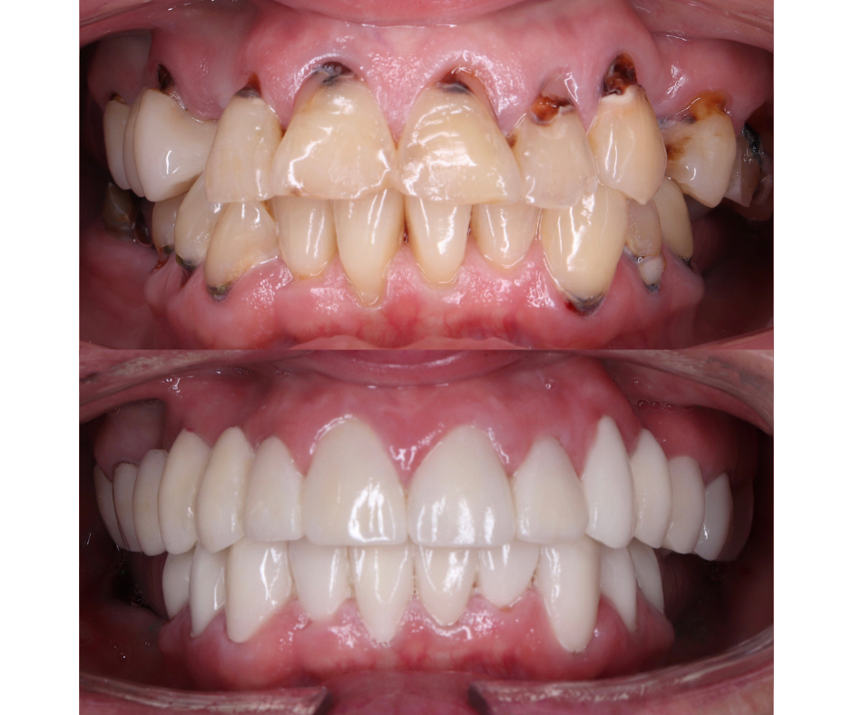 Full Mouth Rehabilitation