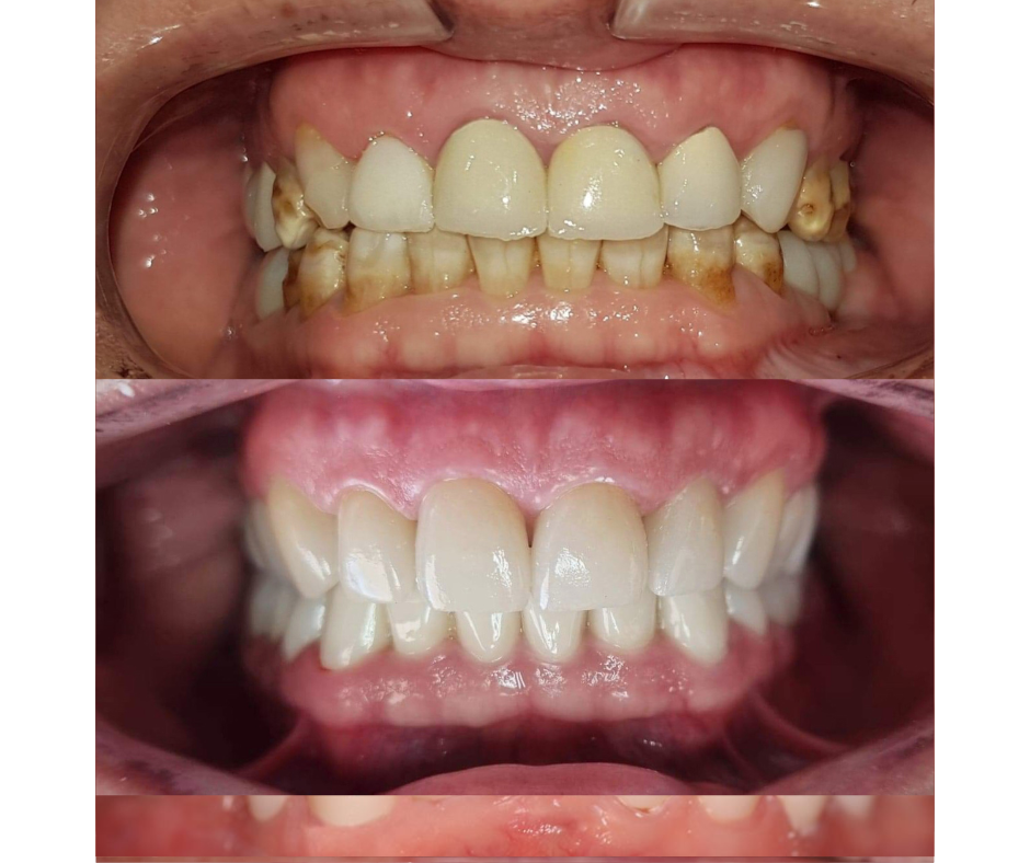 Full Mouth Rehabilitation