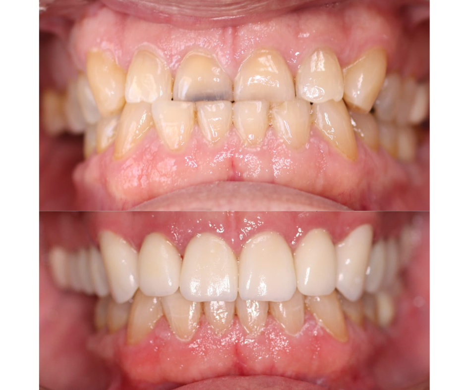 Upper zirconium Crowns