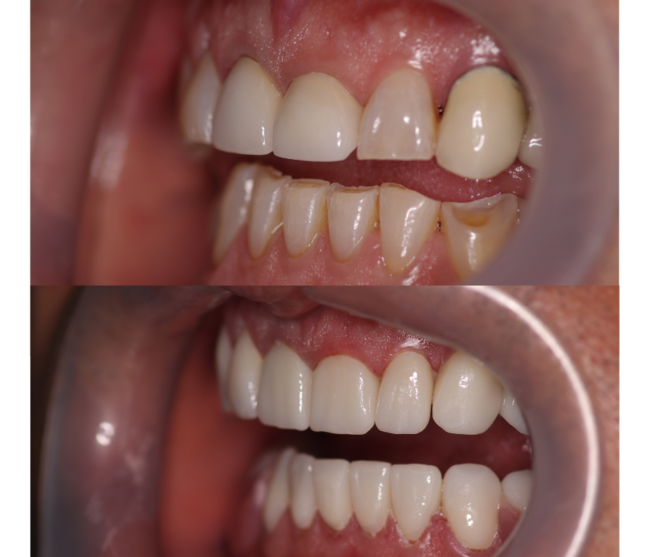 Side view of a before and after full zirconium crowns