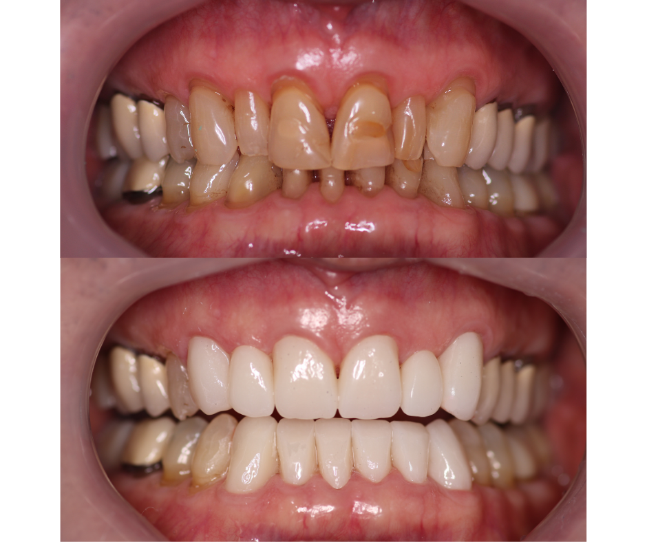 Before and after 12 zirconium crowns