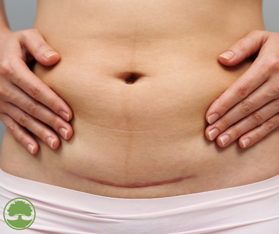 c section scar on woman for scar tissue therapy