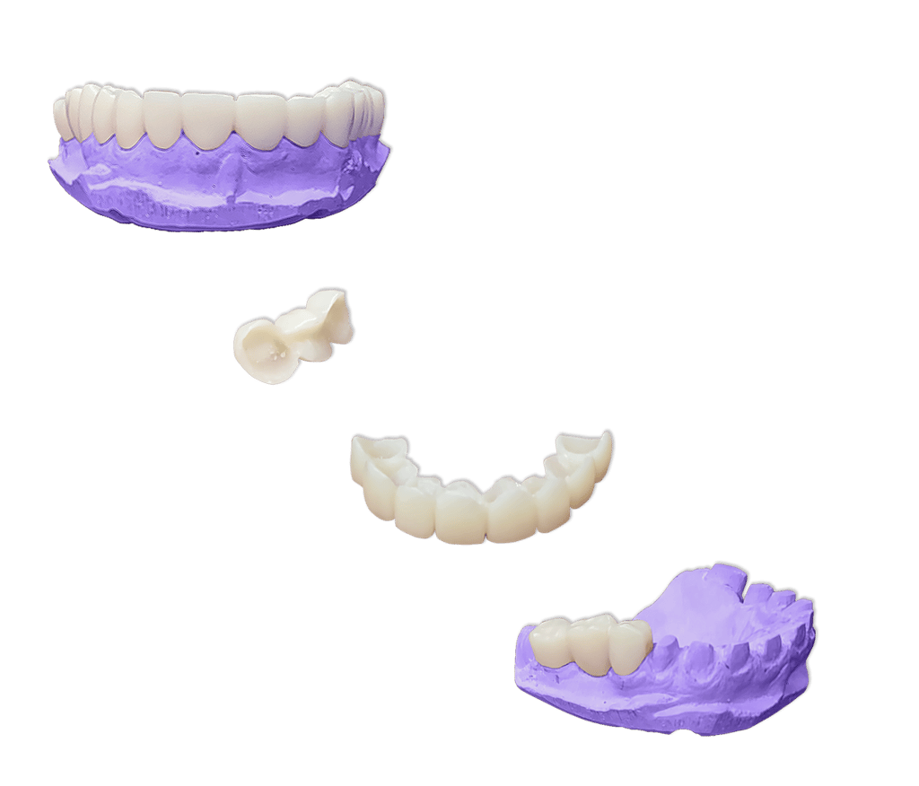 Protesis-Fija-Provisional-Acrilico-Rapido