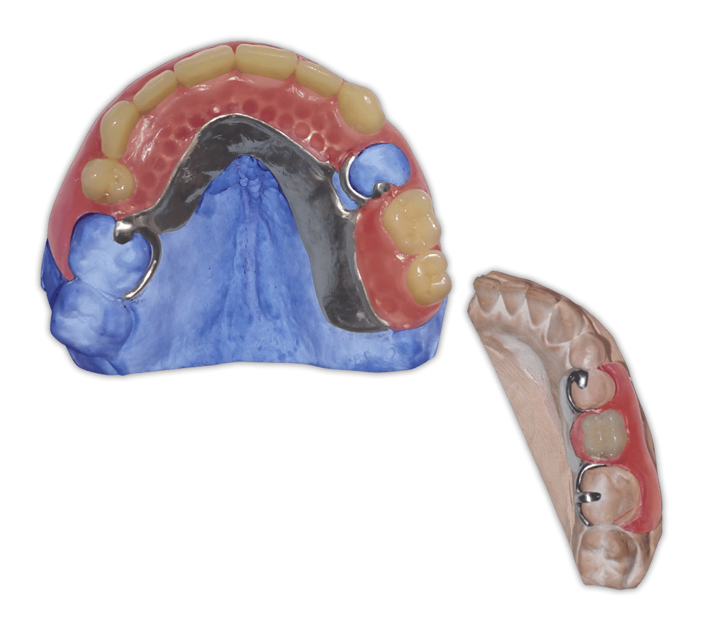 Protesis-Removible-Hibrida-Metal-Flexible-Valplast