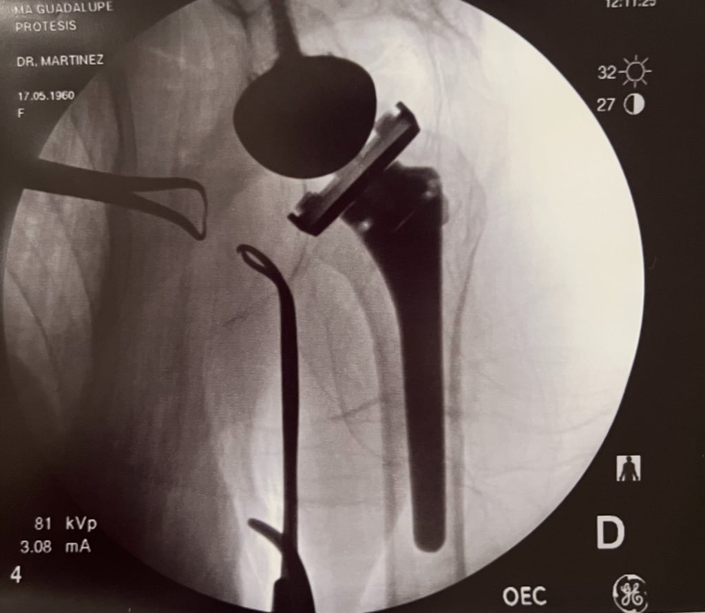 Control de radiografía de prótesis reversa de hombro.