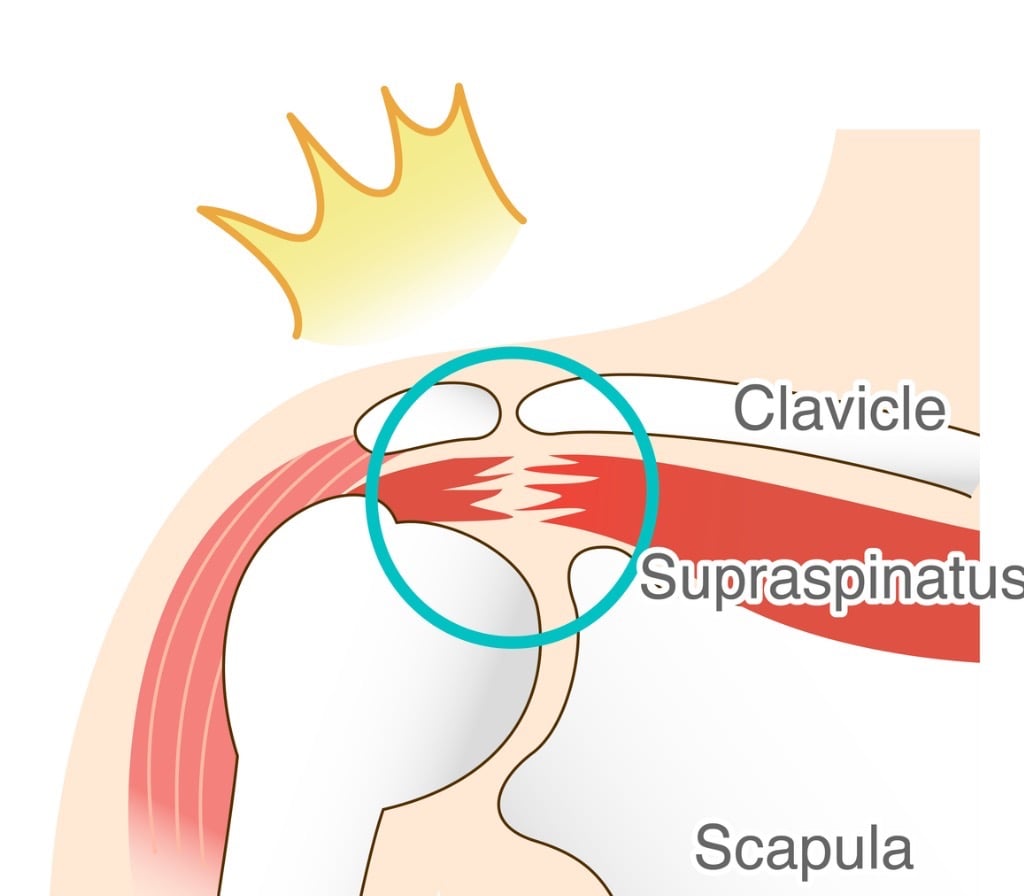 anatomic image of a torn rotator cuff muscle highlighted to indicate pain