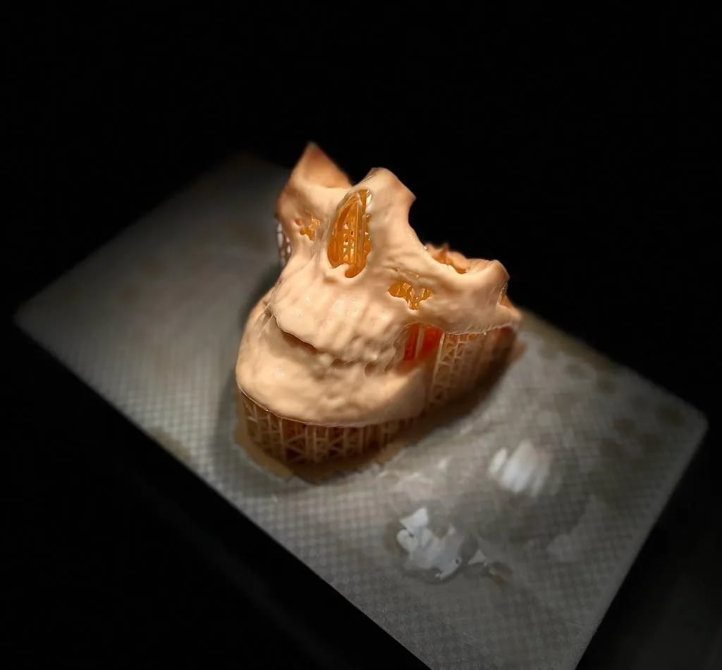3D printed maxillofacial model