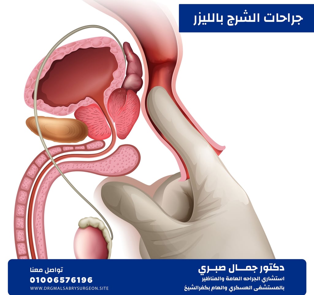 علاج الشرج بالليزر