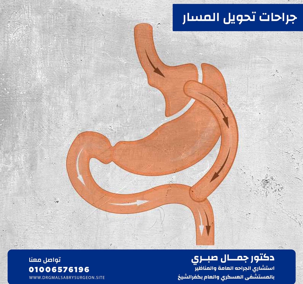 جراحات تحويل المسار