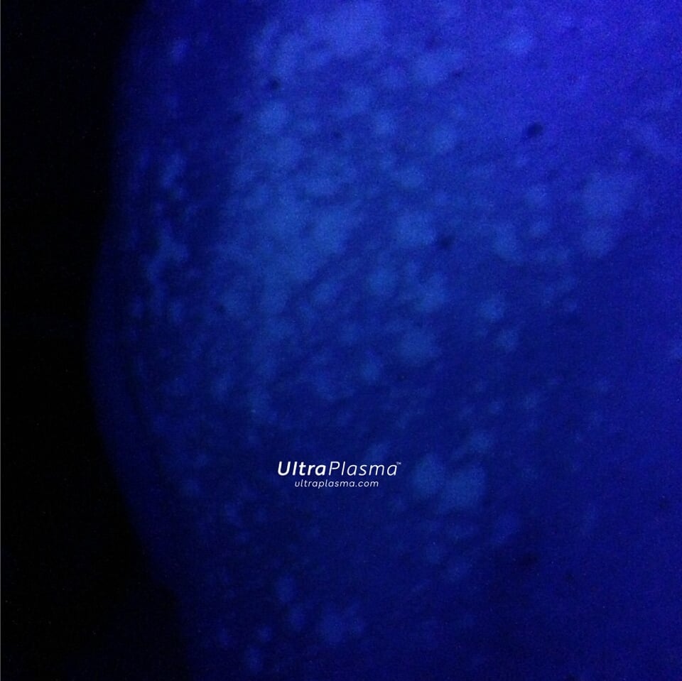 ultraplasma.com Tinea Versicolor woodlamp diagnosis