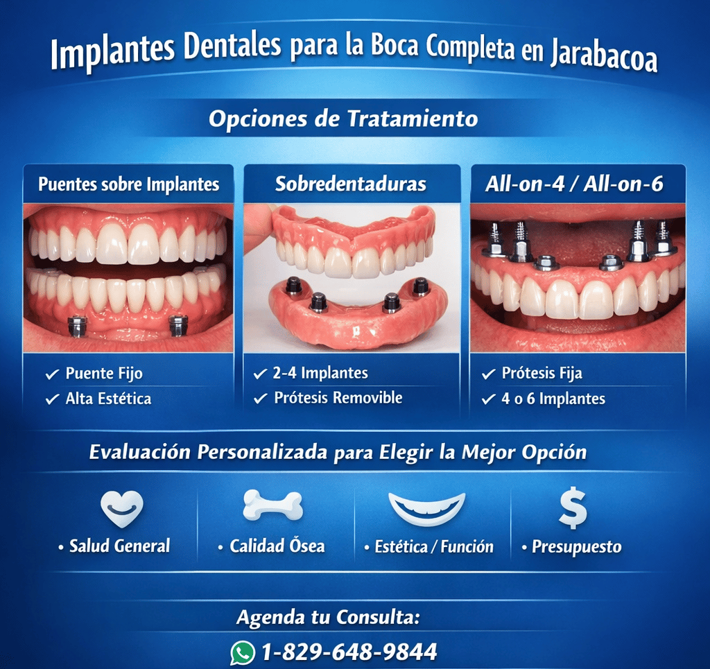 Implantes dentales para la boca completa en Jarabacoa.