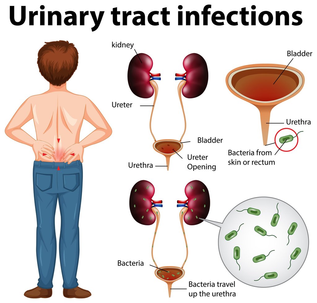 UTI