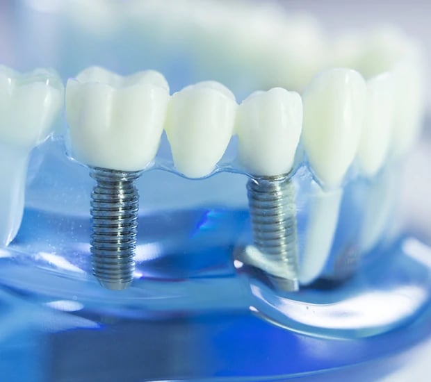 dental-implants-dJo4nvMlX2uVw87Z