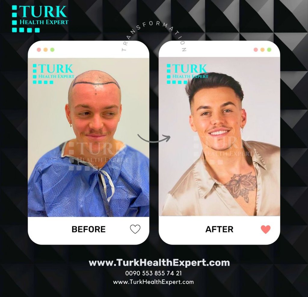 greffe cheveux turk health expert