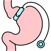 gastric band