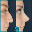 Resultados de Rinoplastia