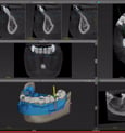 Implant Surgical guide design