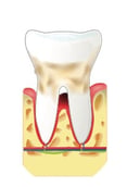 Parodontie médecine jet dentaire ozone hygiene-precision