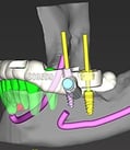 CBCT virtual planning