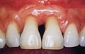 déchaussement dents hygiene-precision.com