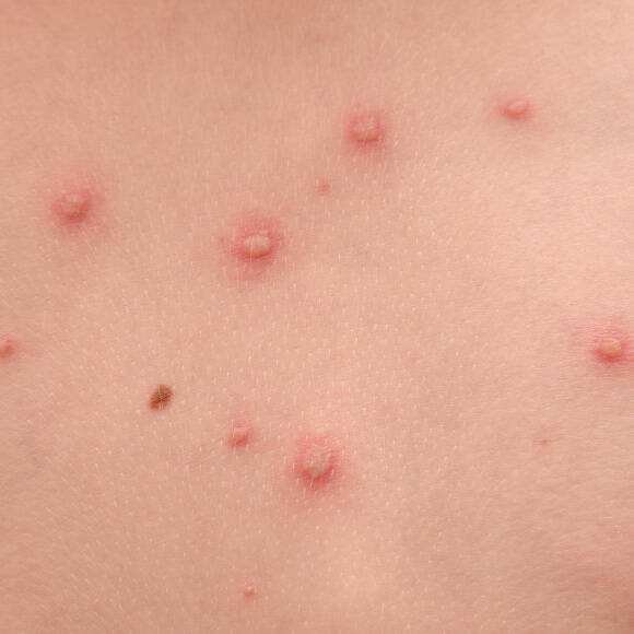 Chickenpox in children: symptoms, treatment, and prevention | Centre ...