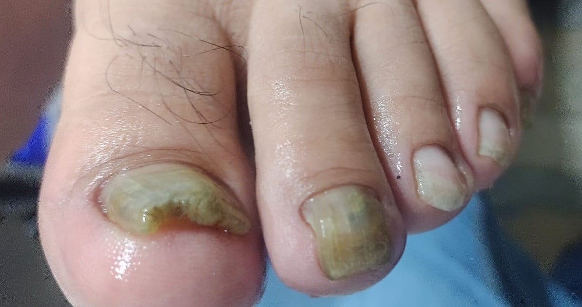 Onicomicosis: Guía Completa para Entender y Tratar los Hongos en las ...