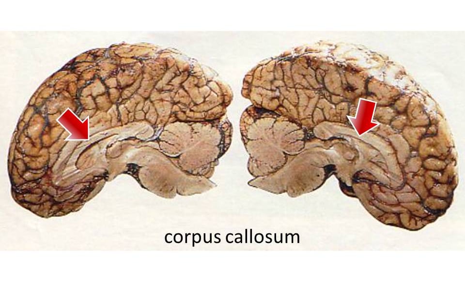 Lets know how split brain surgery revolutionized neuroscience through Sperry and Gazzaniga's groundbreaking work. Learn how corpus callosotomy rev