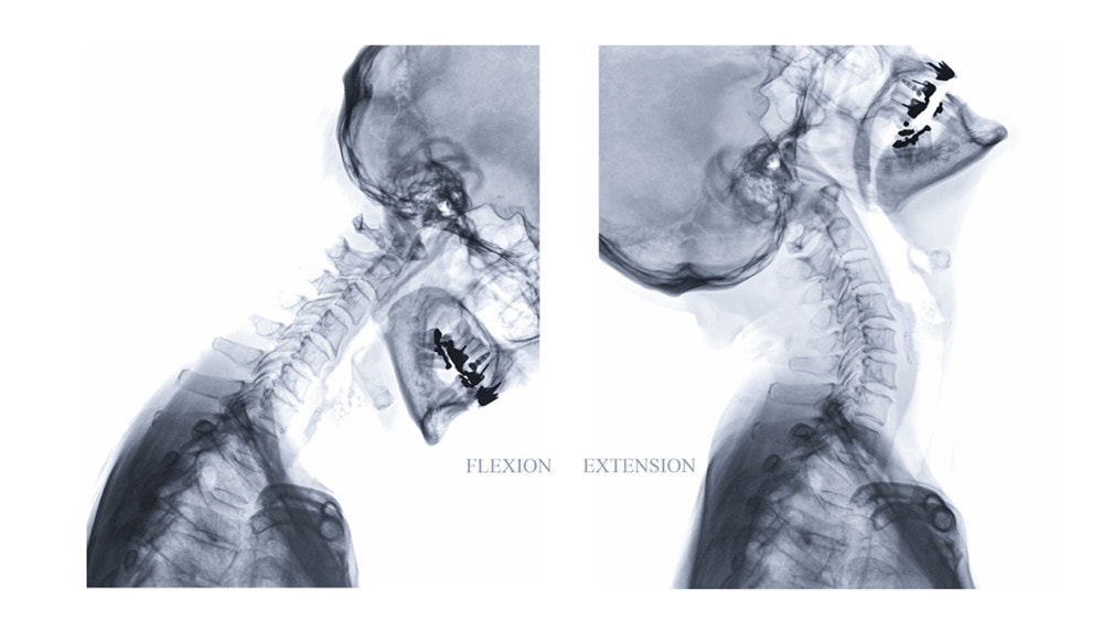 Understanding Flexion-Extension X-Rays and Spinal Instability | Anodyne ...