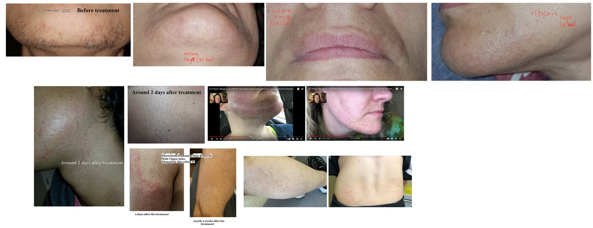 skin-after-electrology-treatment