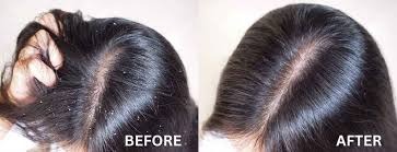 Skindent's Rejuvenate Dandruff Treatment