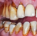 image parodontite hygiene-precision.com