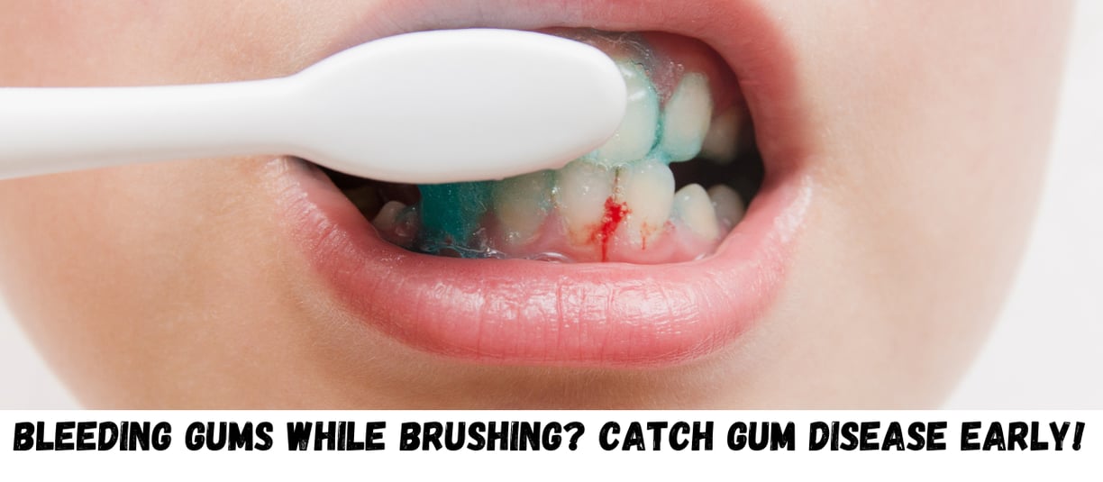 Bleeding Gums