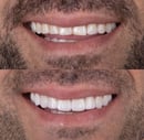 Facetas antes e depois dente pequeno