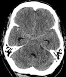 Tomografia computadorizada de um homem de 45 anos com hematoma intracerebral.