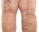 Varicose Veins