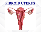 Fibroid Utersu