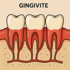 Parodontie la gingivite hygiene-precision.com
