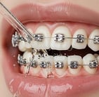 nettoyer appareil orthodontique hygiene-precision.com