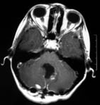 Ressonância após a cirurgia com remoção total do tumor e melhora dos sintomas.