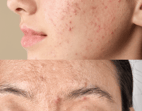 Acne and dark spots treatment