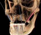 zygoma implant planning, all on 4 , all on 6 implants