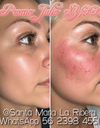Tratamientos faciales y láser Belle Santa Maria la Ribera CDMX