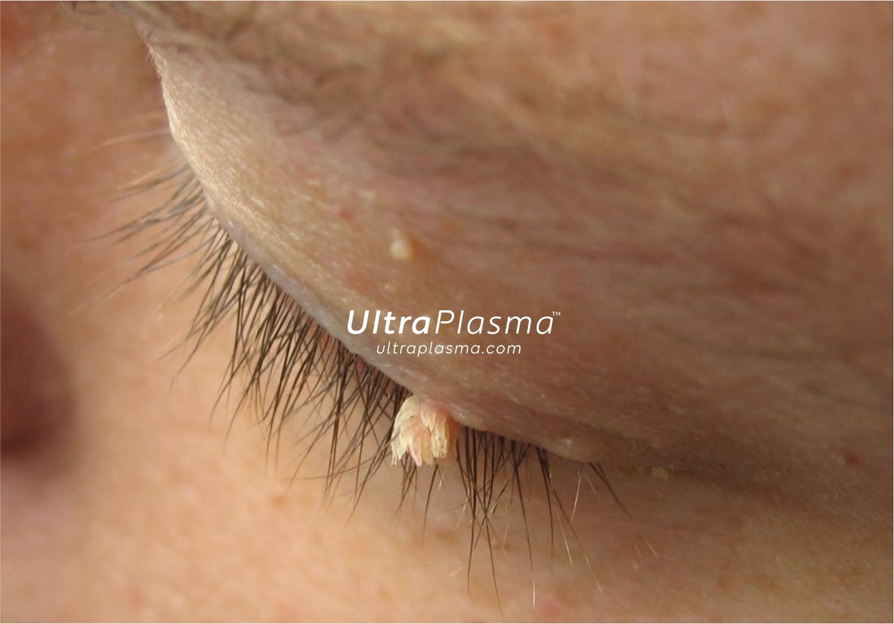 ultraplasma.com_wart_treatment_sigil_tedavisi_ultra_plasma_ultra_plazma