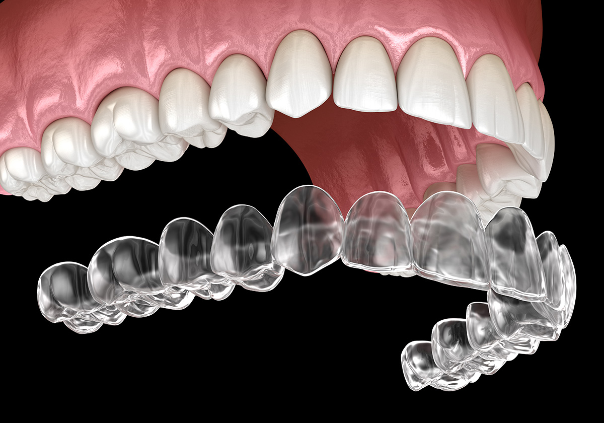 Modello di Invisalign - Gambara 