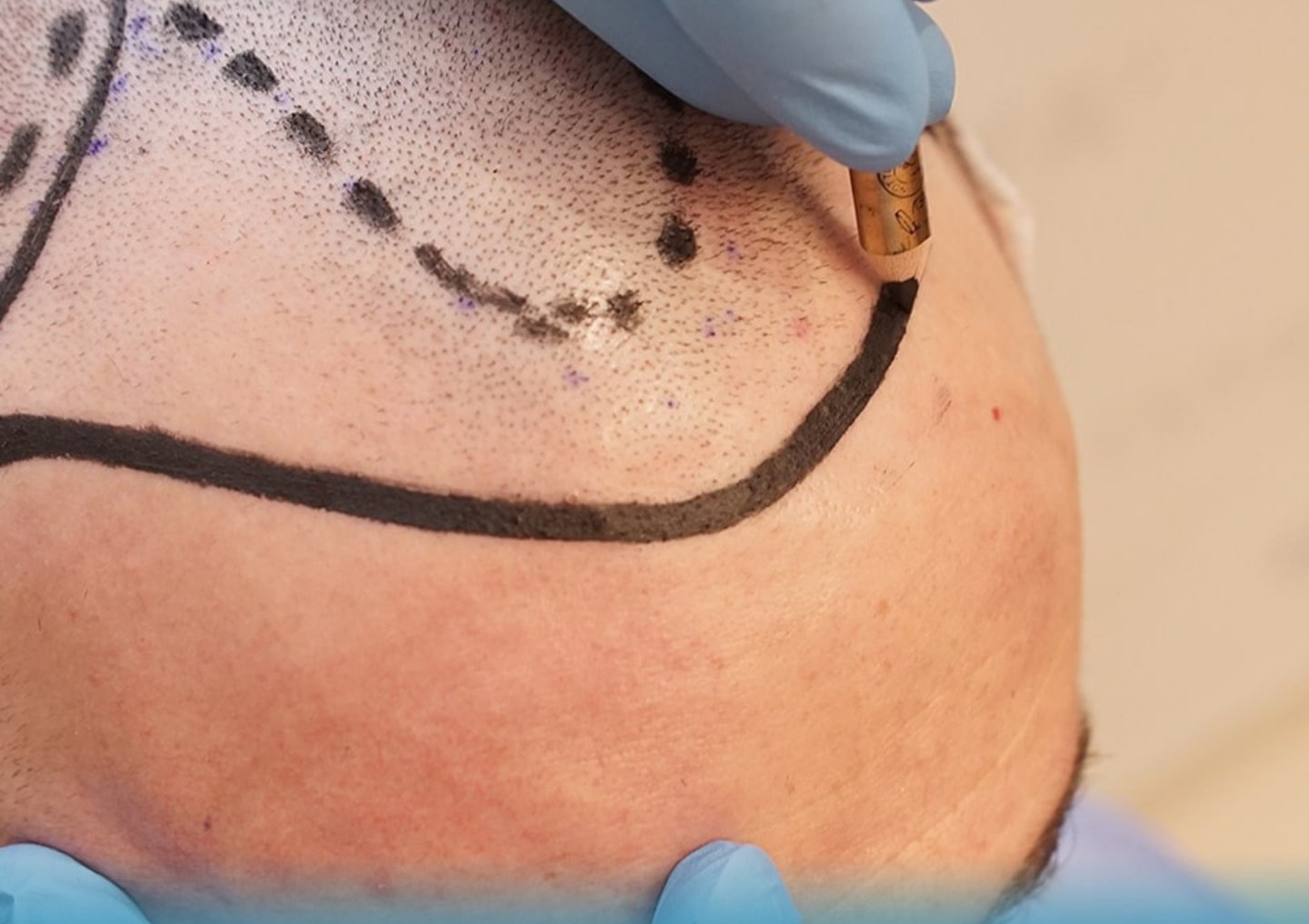transplantation capillaire en Algérie, chirurgie esthétique cheveux Algérie, esthétique, جمالي, جمال