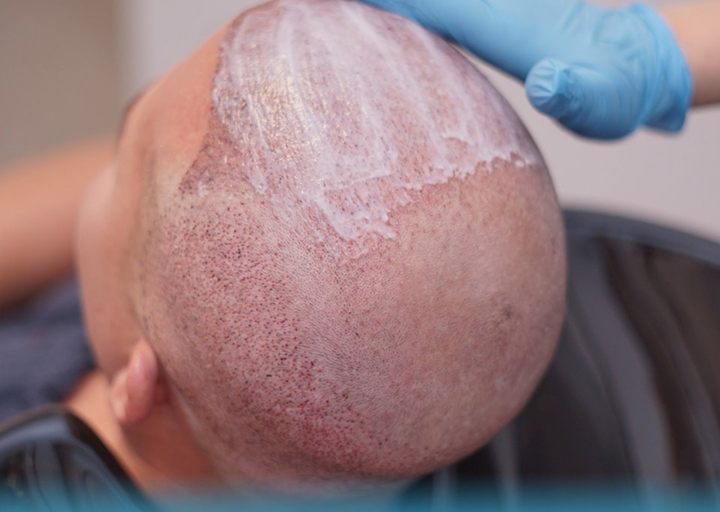 زراعة الشعر الطبيعي الجزائ, أفضل مركز تجميل للزراعة, نتائج زراعة الشعر, مراحل زراعة الشع, العناية با